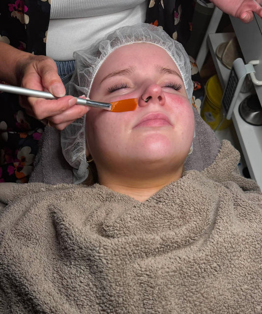 Kemisk peeling i forbindelse med Dr. Hauck behandlinger